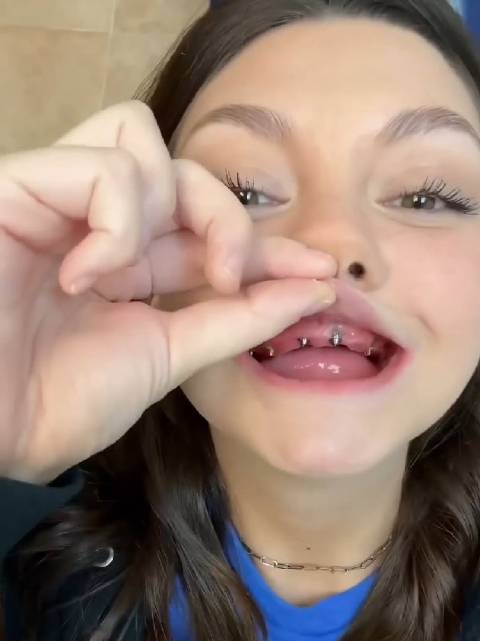 A 32-year-old woman has only four teeth left in her mouth