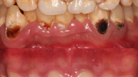 After 95, the woman's nasal congestion was found to be cancer after 2 months
