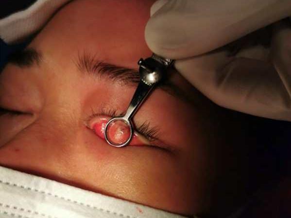 医生回应女子眼角掉出74根眼睫毛插图 医生回应女子眼角掉出74根眼睫毛