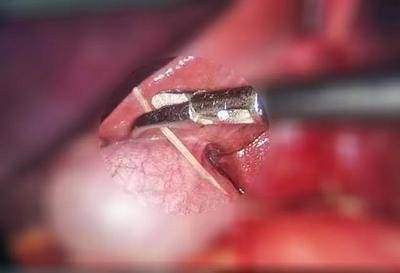 Woman eats hot pot and gets throat stuck by fish bone, causing esophageal rupture