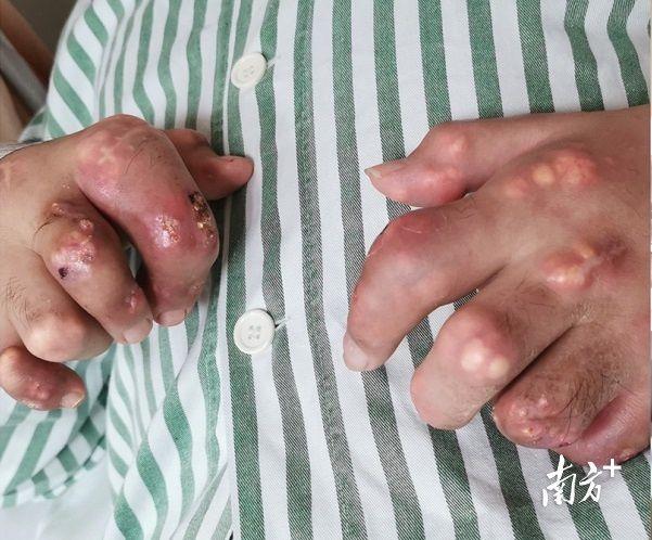 小伙长期喝饮料双手长满痛风石