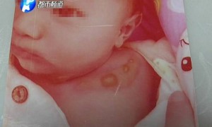 月嫂烫伤出生27天婴儿