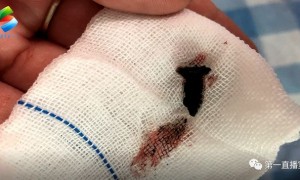 男孩鼻子恶臭两年 取出颗生锈螺丝