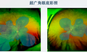 粉丝模仿水花消失术致视网膜脱离