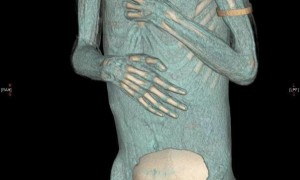 6岁男童颅骨寄养腹部1个半月