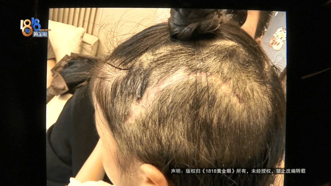 5岁女童游乐园头皮撕裂头骨露出插图 5岁女童游乐园头皮撕裂头骨露出插图